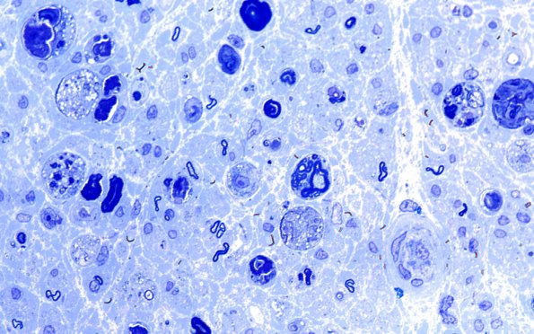 8A2 Axonal degeneration (Case 8) Plastic 100X 3