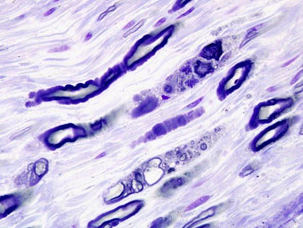 8A3 Axonal Degeneration (Case 8) Plastic 1