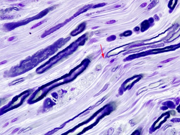 8A4 Axonal Degeneration (Case 8) Plastic 3 copy
