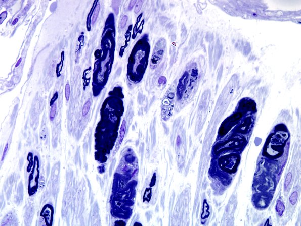 9A1 Axonal degeneration, active (Case 9) Plastic 11.jpg