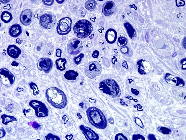 9A2 Axonal degeneration, active (Case 9) Plastic 12.jpg