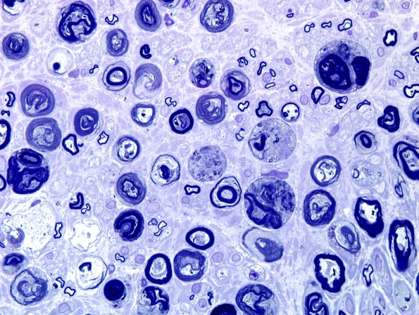 9A3 Axonal degeneration, active (Case 9) Plastic 13.jpg