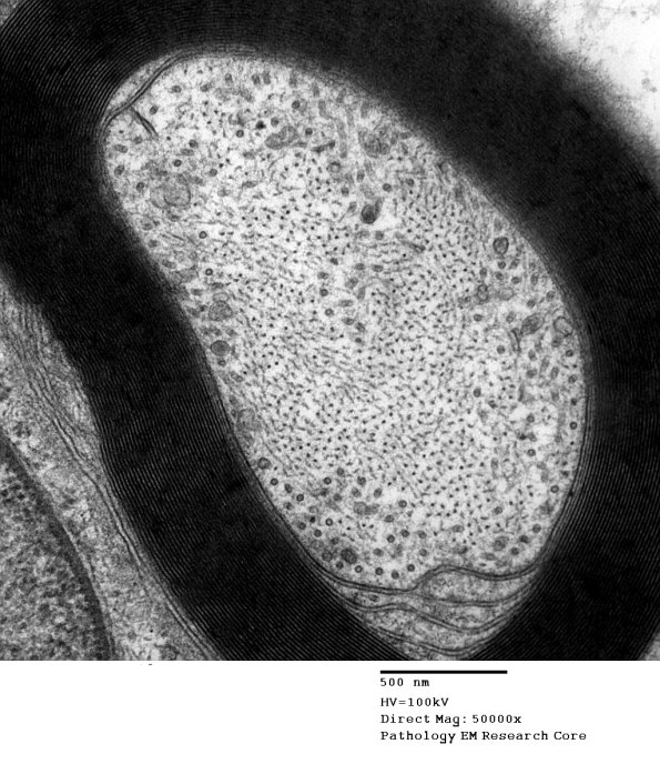 1A Axonal degeneration, (Case 1) EM 003 - Copy