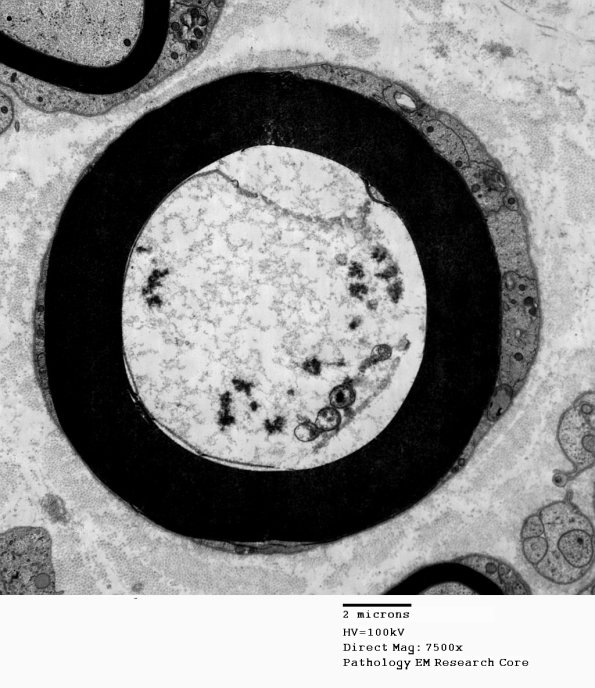 1B1 Axonal degeneration, (Case 2) EM 007 - Copy