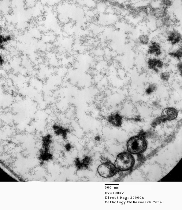 1B2 Axonal degeneration, (Case 2) EM 008 - Copy