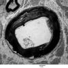 1D1 Axonal Degeneration, early (Case 4) EM 067 - Copy