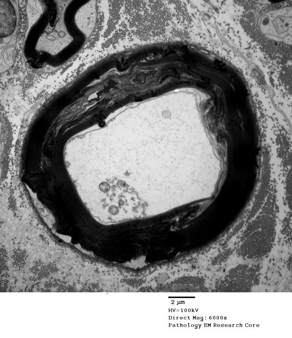 1D1 Axonal Degeneration, early (Case 4) EM 067 - Copy