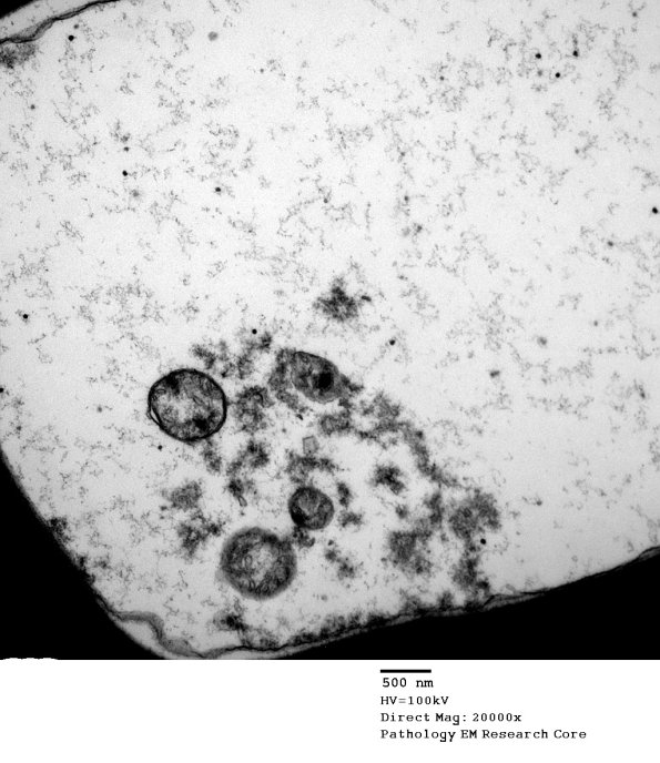 1D2 Axonal Degeneration, early (Case 4) EM 069 - Copy