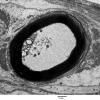 1D3 Axonal Degeneration, early (Case 4) EM 074 - Copy