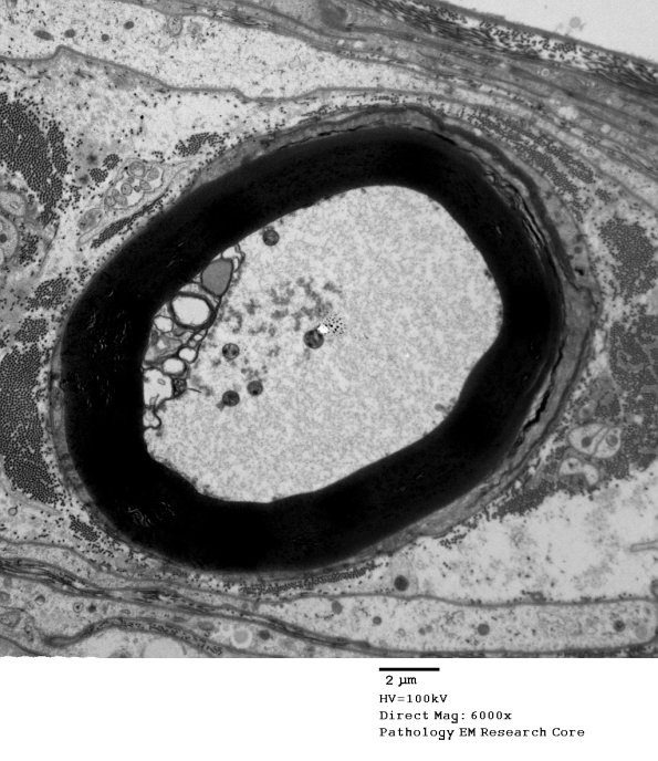 1D3 Axonal Degeneration, early (Case 4) EM 074 - Copy