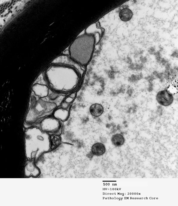 1D4 Axonal Degeneration, early (Case 4) EM 075 - Copy