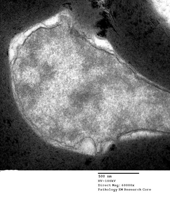 1D6 Axonal Degeneration, early (Case 4) EM 052 - Copy