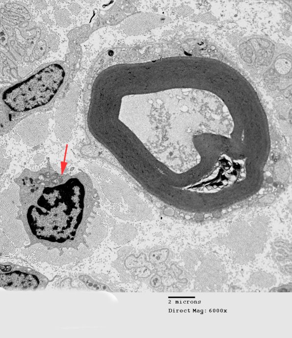 1E1 Axonal Degeneration, granular axoplasm, sarcoid (Case 5) EM 035 - Copy copy