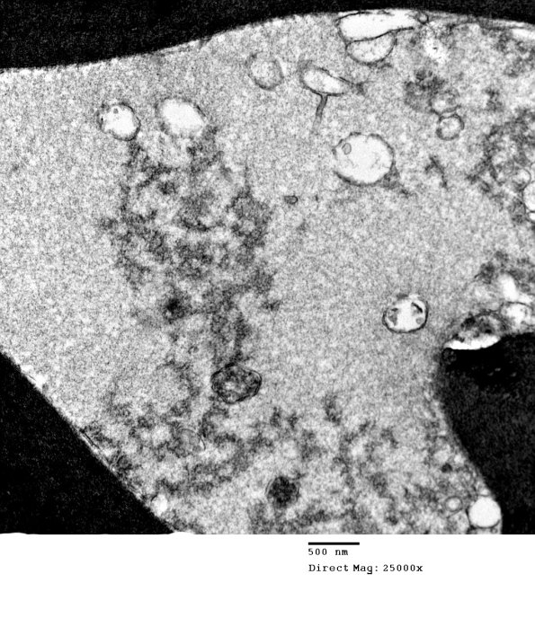 1E2 Axonal Degeneration, granular axoplasm, sarcoid (Case 5) EM 037 - Copy