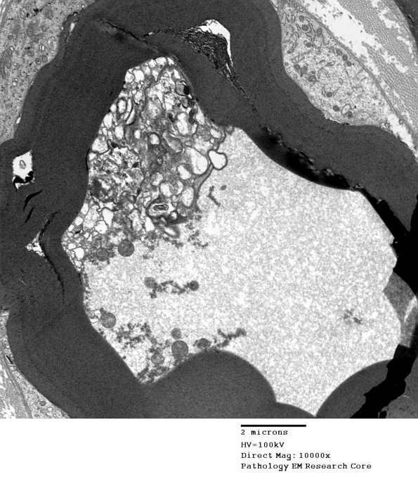 1G1 Axonal Degeneration (Case 7) EM 032a - Copy