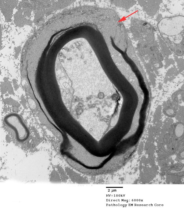 1H (Case 8)  Nerve_007 - Copy copy