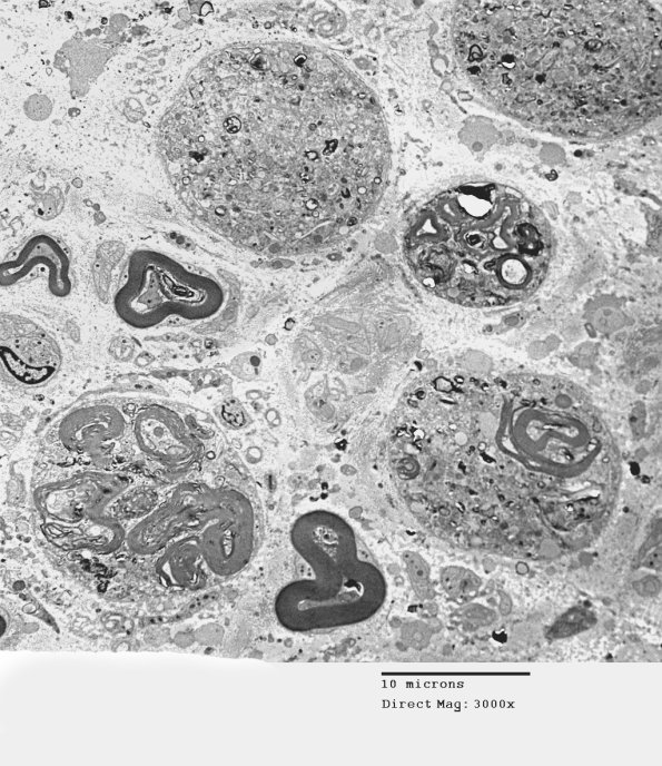 2A1 Axonal Degeneration (Case 9) EM 050 - Copy