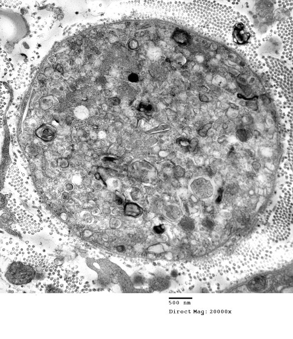 2A2 Axonal Degeneration (Case 9) EM 026A - Copy