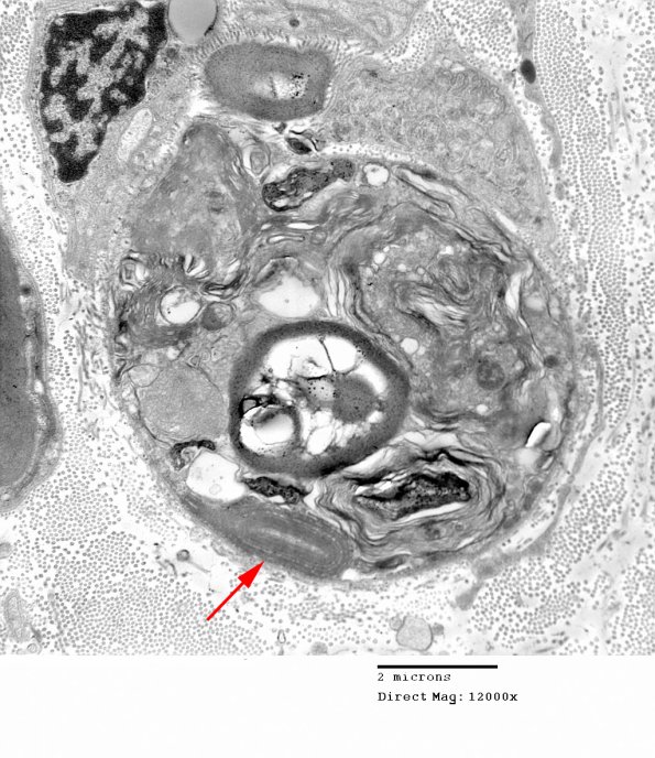 2A3 Axonal Degeneration (Case 9) EM 030 - Copy copy