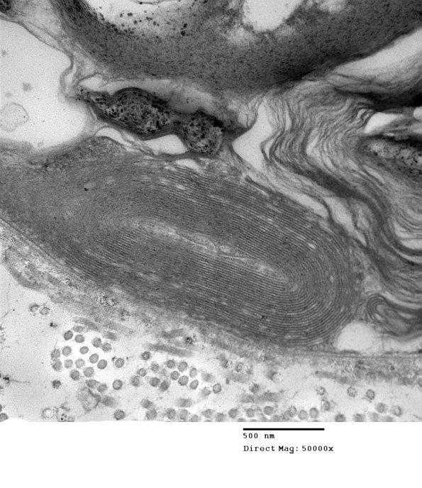 2A4 Axonal Degeneration (Case 9) EM 032 - Copy