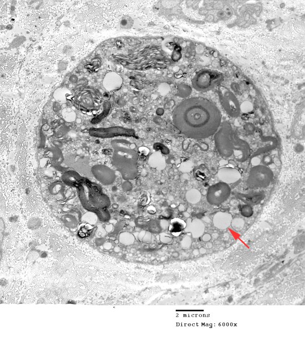 2A5 Axonal Degeneration (Case 9) EM 039 - Copy copy