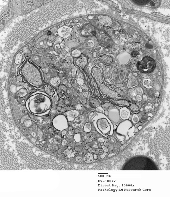 2B1 Axonal Degeneration (Case 7) EM 003 - Copy