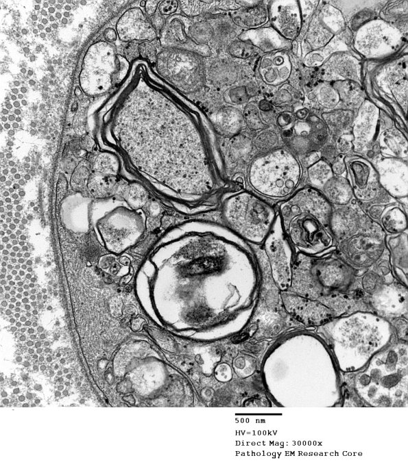 2B2 Axonal Degeneration (Case 7) EM 004 - Copy