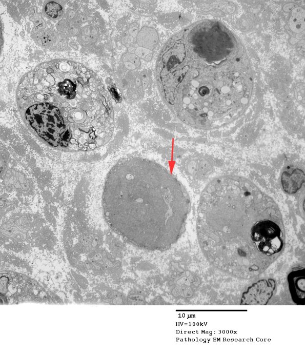 2C5 (Case 10) EM 177 - Copy copy