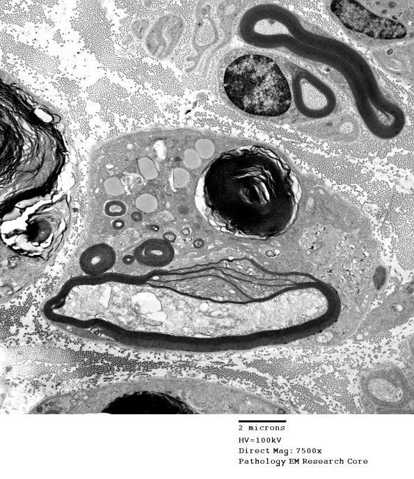 2D1 Axonal Degeneration (Case 11) EM 021 - Copy