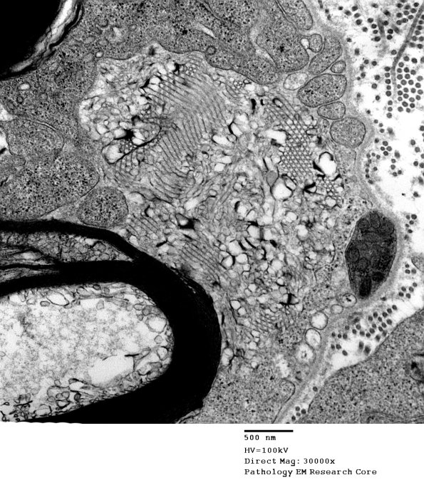 2D2 Axonal Degeneration (Case 11) EM 026 - Copy