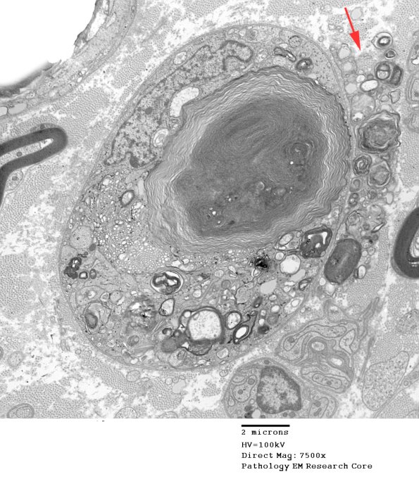 2E1 Axonal Degeneration (Case 7) EM 006 - Copy copy
