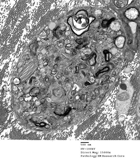 2E3 Axonal Degeneration (Case 7) EM 004 - Copy