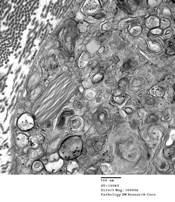 2E4 Axonal Degeneration (Case 7) EM 005 - Copy