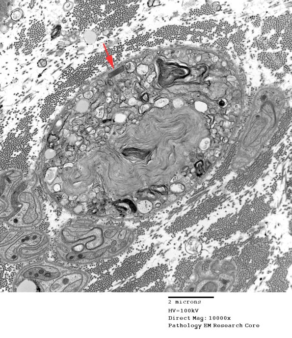 2E5 Axonal Degeneration (Case 7) EM 033 - Copy copy