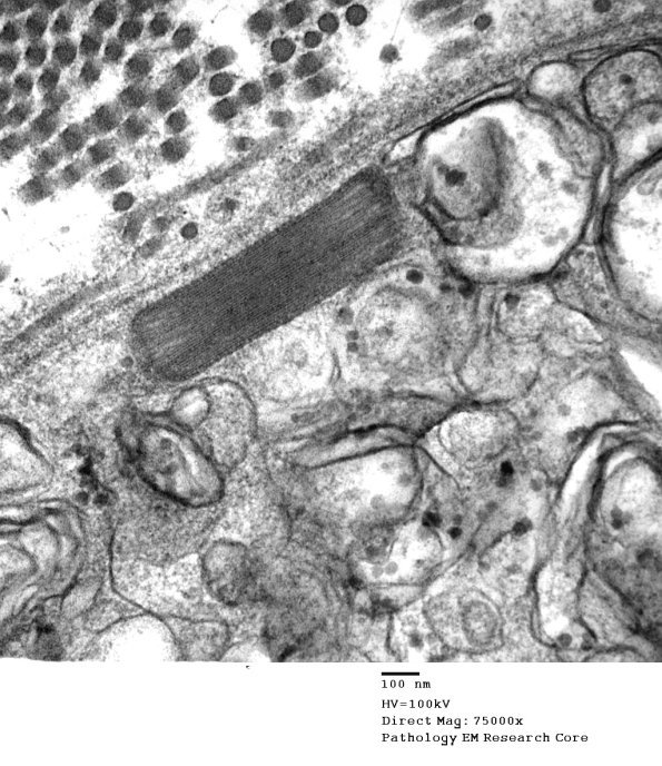 2E6 Axonal Degeneration (Case 7) EM 035 - Copy