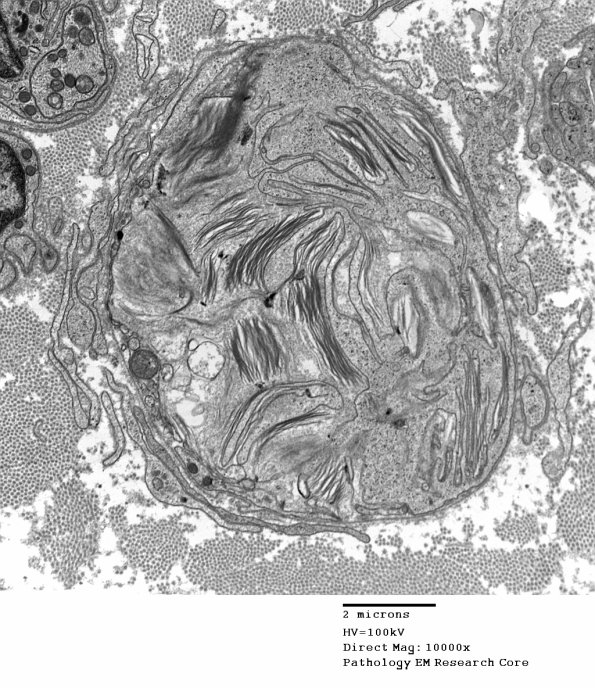 2E7 Axonal Degeneration (Case 12) 027 - Copy