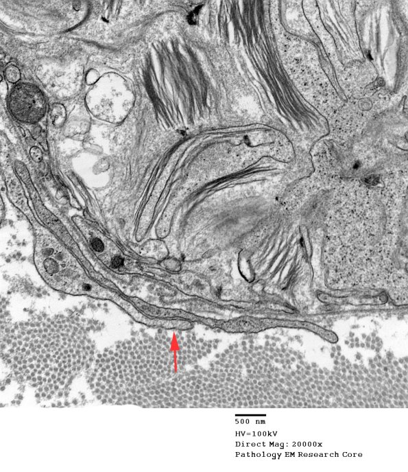 2E8 Axonal Degeneration (Case 12) 028 - Copy copy
