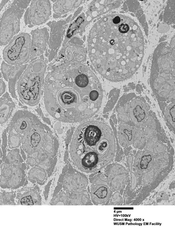 2F2 (Case 13) EM 038 - Copy