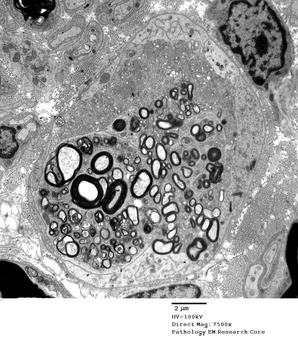 2G1 Axonal Degeneration (Case 7) EM 016B - Copy