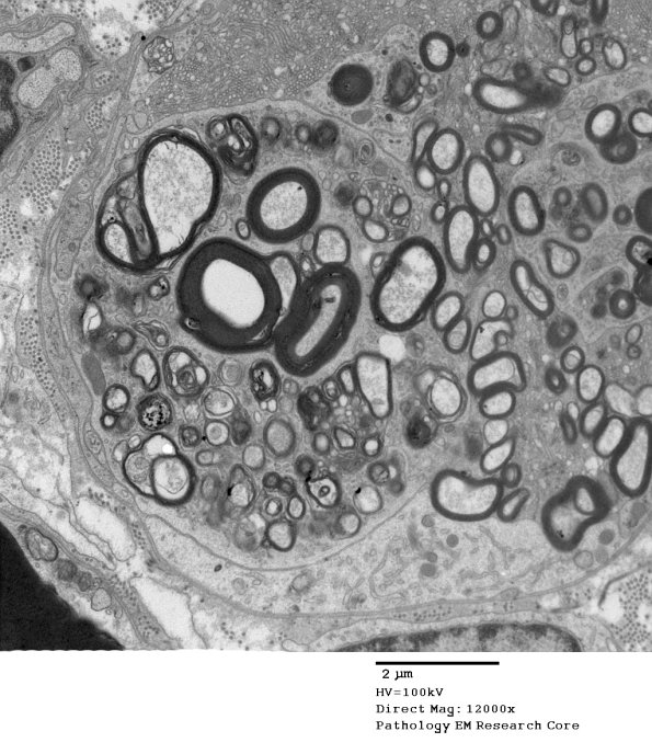 2G2 Axonal Degeneration (Case 7) EM 018A - Copy