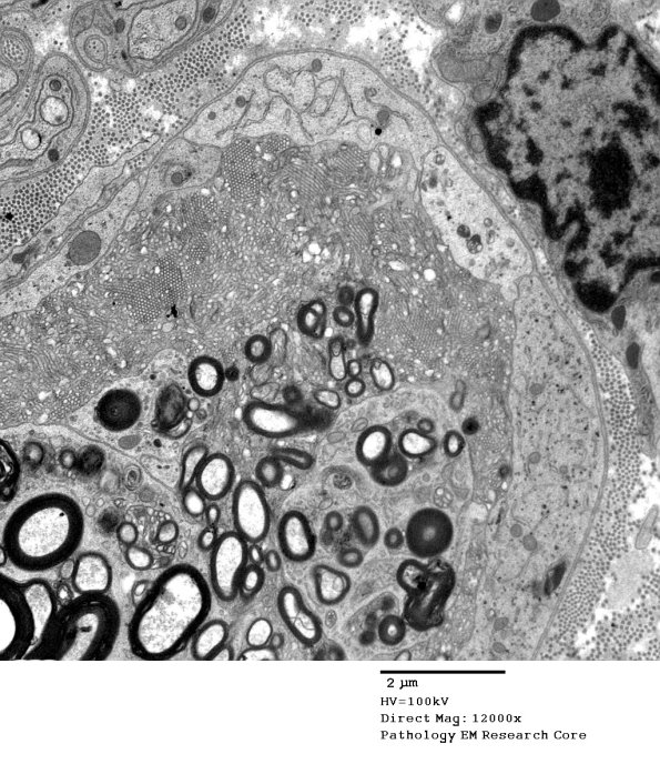 2G3 Axonal Degeneration (Case 7) EM 017A - Copy