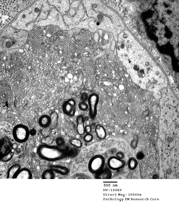 2G4 Axonal Degeneration (Case 7) EM 019A - Copy