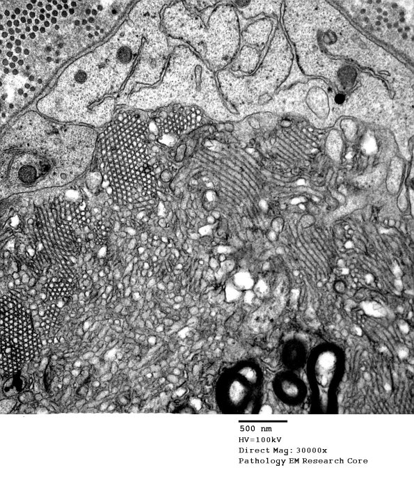 2G5 Axonal Degeneration (Case 7) EM 020A - Copy