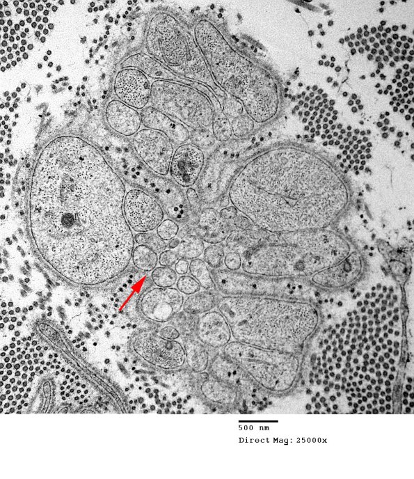 4A1 Bands of Bungner (Case 15) EM 025 - Copy copy