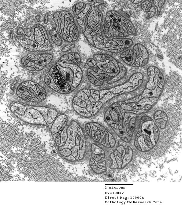 4B2 Axonal Degeneration (Case 16) 039 - Copy