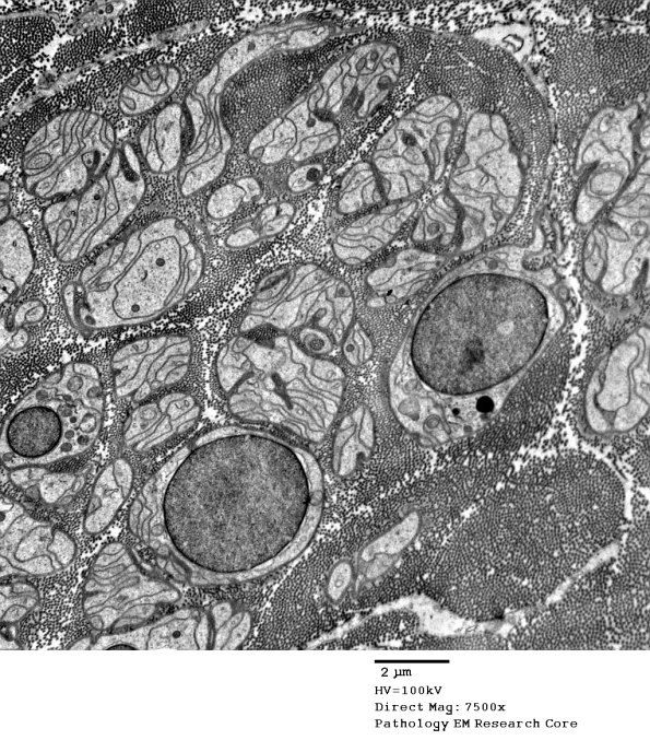 4C1 Axonal Loss, myelinated, near complete (Case 16) EM 020 - Copy