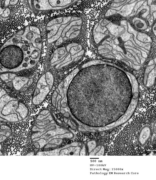 4C2 Axonal Loss, myelinated, near complete (Case 16) EM 034 - Copy
