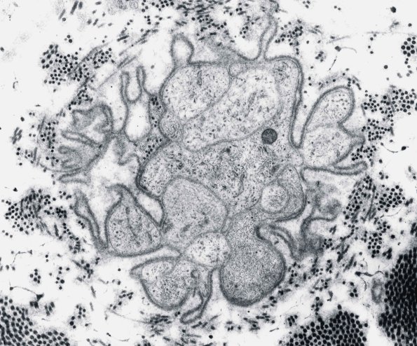 4D1 Axonal degeneration, band of Bungner EM 1 - Copy