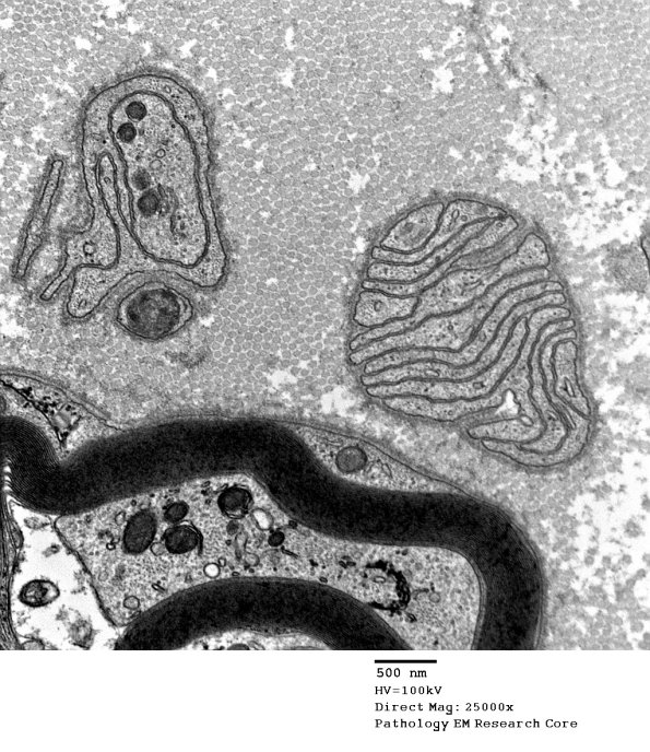 4E Bands of Bungner, unmyelinated bands (Case 17) EM 047 - Copy
