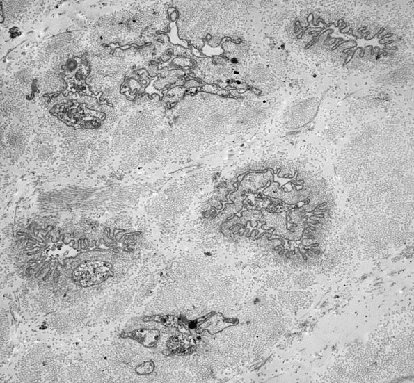 4F Axonal Degeneration (Case 18) residual basal lamina EM 1 - Copy